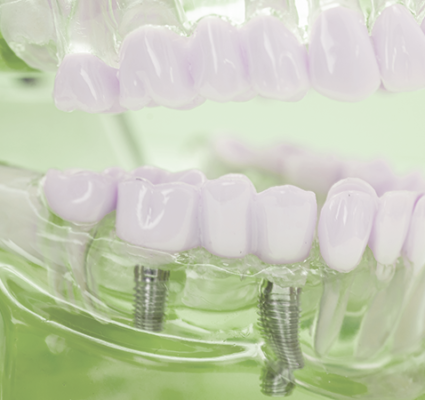 زراعة الأسنان